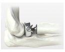 Skeletal Dynamics ALIGN Radial Head System | Which Medical Device